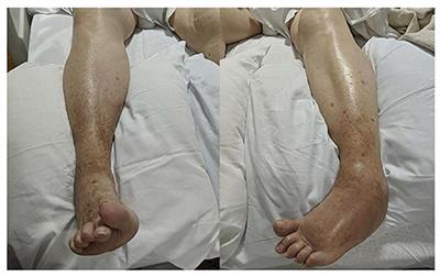 Case Report: Amphiphysin Antibody-Associated Stiff-Limb Syndrome and Myelopathy: An Unusual Presentation of Breast Cancer in an Elderly Woman